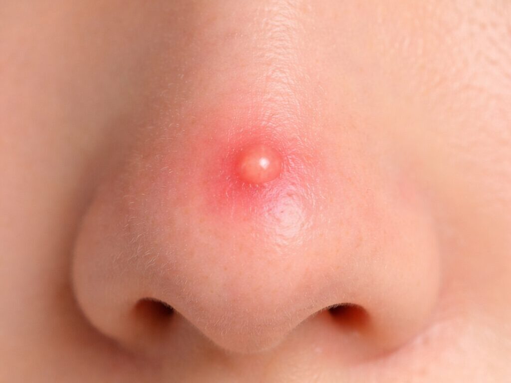 鼻子痘痘感染致命